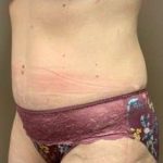 Tummy Tuck Before & After Patient #1354