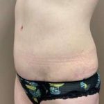 Tummy Tuck Before & After Patient #1364