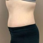Tummy Tuck Before & After Patient #1371