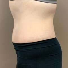 Tummy Tuck Before & After Patient #1371