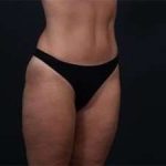 Tummy Tuck Before & After Patient #1378