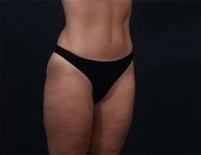 Tummy Tuck Before & After Patient #1378