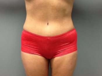 Mommy Makeover Before & After Patient #1395