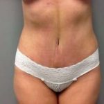 Mommy Makeover Before & After Patient #1445