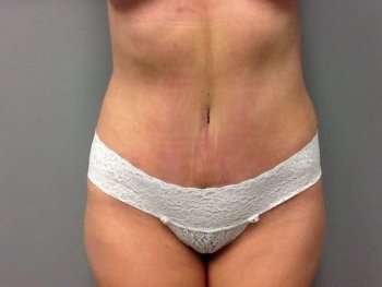 Mommy Makeover Before & After Patient #1445