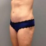 Liposuction Before & After Patient #1485