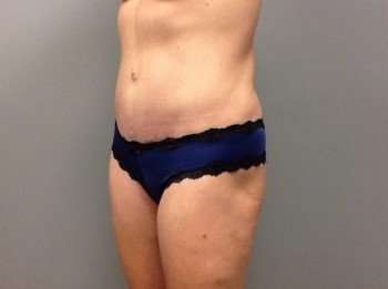Liposuction Before & After Patient #1485