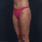 Liposuction Before & After Patient #1492
