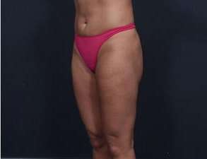 Liposuction Before & After Patient #1492