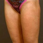 Liposuction Before & After Patient #1499
