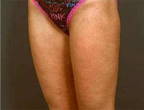 Liposuction Before & After Patient #1499