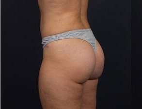 Liposuction Before & After Patient #1506