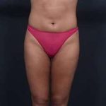Liposuction Before & After Patient #1513