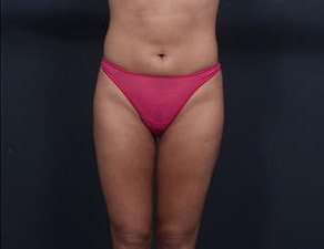 Liposuction Before & After Patient #1513