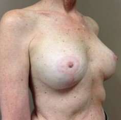 Breast Mastopexy Before & After Patient #228