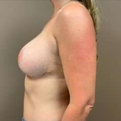Breast Mastopexy Before & After Patient #233