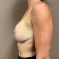 Breast Mastopexy Before & After Patient #245