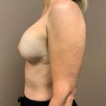 Breast Mastopexy Before & After Patient #90