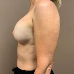 Breast Mastopexy Before & After Patient #90
