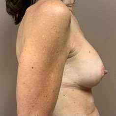 Breast Mastopexy Before & After Patient #266
