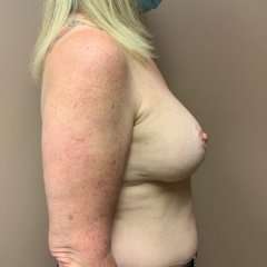 Breast Mastopexy Before & After Patient #276