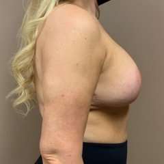 Breast Mastopexy Before & After Patient #302