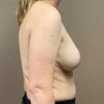 Breast Mastopexy Before & After Patient #307