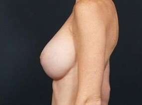 Breast Implant Revision Replacement Before & After Patient #384