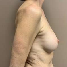 Breast Implant Revision Replacement Before & After Patient #389