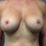 Breast Implant Revision Replacement Before & After Patient #394