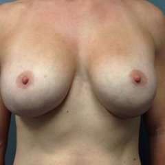 Breast Implant Revision Replacement Before & After Patient #394