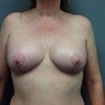 Breast Implant Revision Replacement Before & After Patient #417