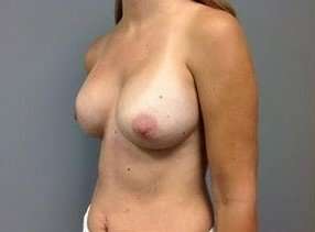 Breast Implant Revision Replacement Before & After Patient #451