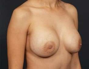 Breast Implant Revision Replacement Before & After Patient #489