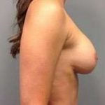Breast Implant Revision Replacement Before & After Patient #508
