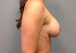 Breast Implant Revision Replacement Before & After Patient #508