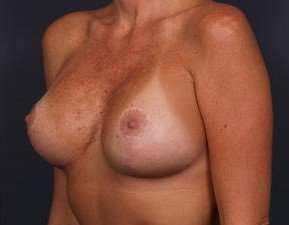 Breast Implant Revision Replacement Before & After Patient #597