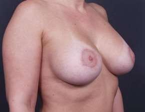 Breast Donut Mastopexy Before & After Patient #615
