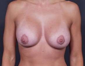 Breast Donut Mastopexy Before & After Patient #634