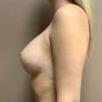 Breast Augmentation Before & After Patient #686