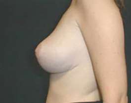 Breast Mastopexy Before & After Patient #148