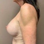 Breast Mastopexy Before & After Patient #221