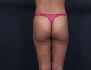 Liposuction Before & After Patient #1492