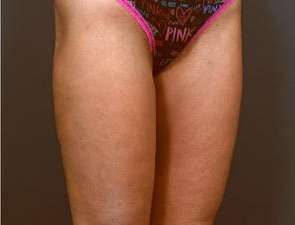 Liposuction Before & After Patient #1499
