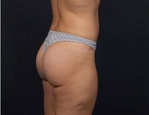 Liposuction Before & After Patient #1506