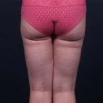 Liposuction Before & After Patient #1513