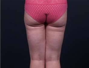 Liposuction Before & After Patient #1513
