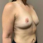 Breast Mastopexy Before & After Patient #295