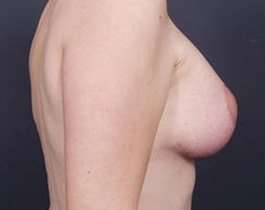 Breast Mastopexy Before & After Patient #155