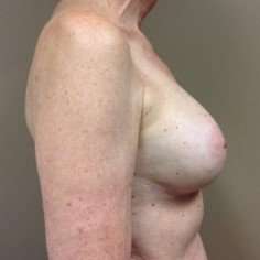 Breast Implant Revision Replacement Before & After Patient #404